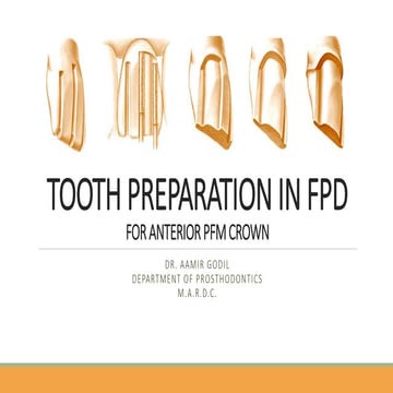 TOOTH PREPARATION: FULL VENEER ANTERIOR PFM