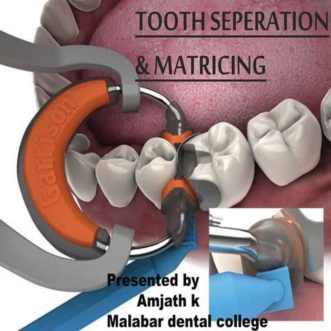 Tooth seperation matrix wedges amjath