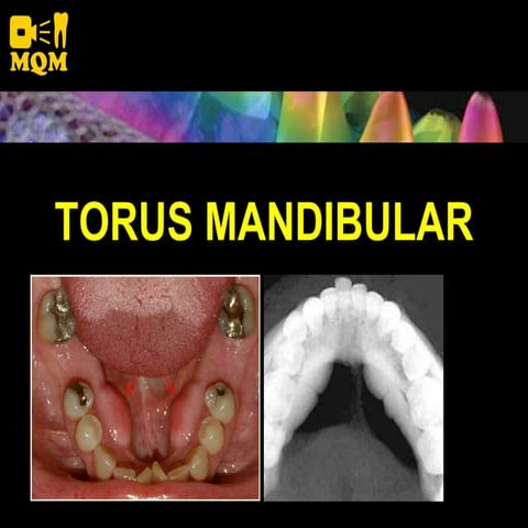 Torus Mandibular | PDF