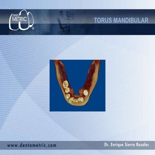 Torus mandibular