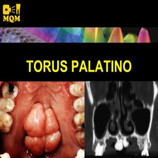 Torus Palatino