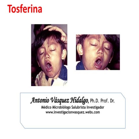 Tosferina