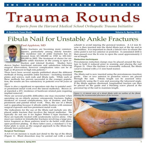 Fibula Nail for Unstable Ankle Fractures