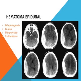 hematoma subdural, epidural, intrap...