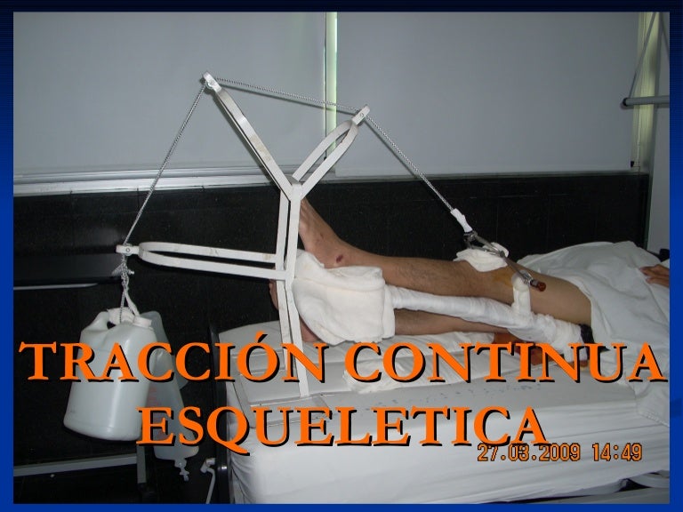 tracci-n-continua-esqueletica