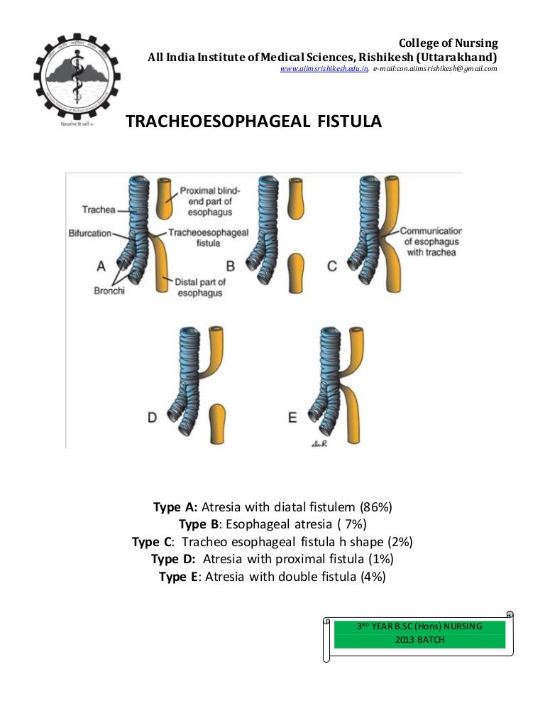 Tracheoesophageal fistula