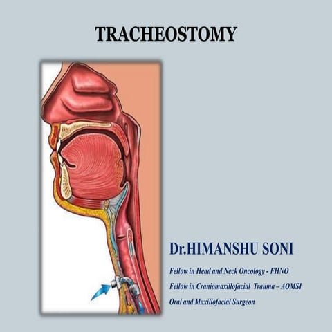 Tracheostomy