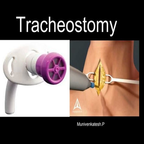 Tracheostomy