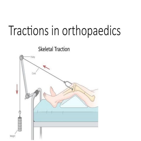 Splints and tractions in orthopedics | PPTX