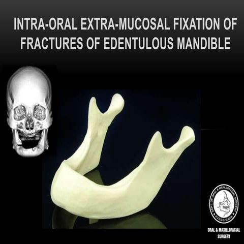 Intra-oral Extra-Mucosal Fixation of Atrophic Mandible