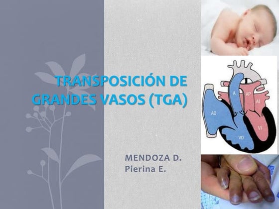 Transposition of great arteries | PPT