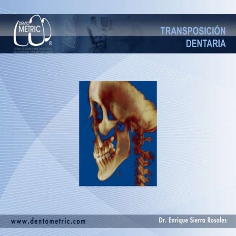 Transposición dentaria