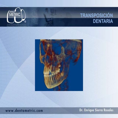 Transposicion dentaria