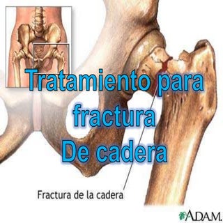 Tratamiento de fractura de cadera