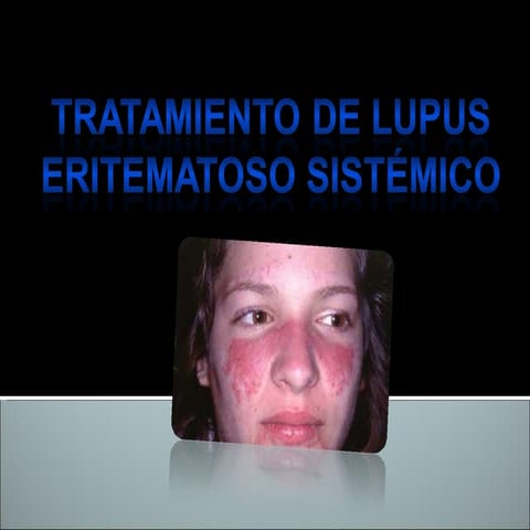 Tratamiento Del Lupus Sistemico