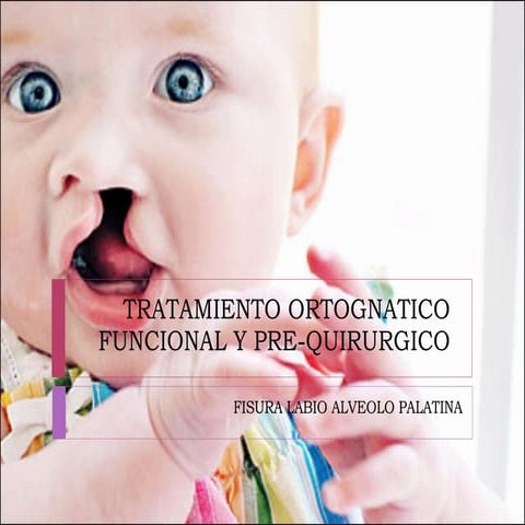 Tratamiento ortopedico prequirurgico de Fisuras