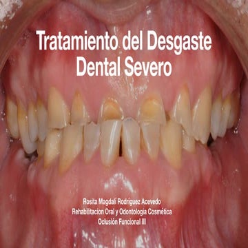 tratamiento del desgaste dental severo .pdf