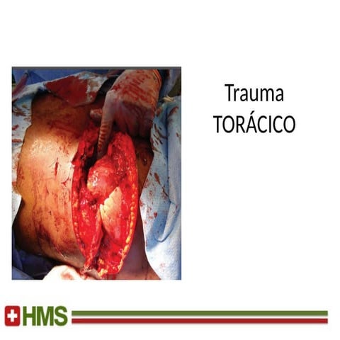TRAUMA DE TORAX  JOSUE.pptxjgvbhfgvvfgvbg