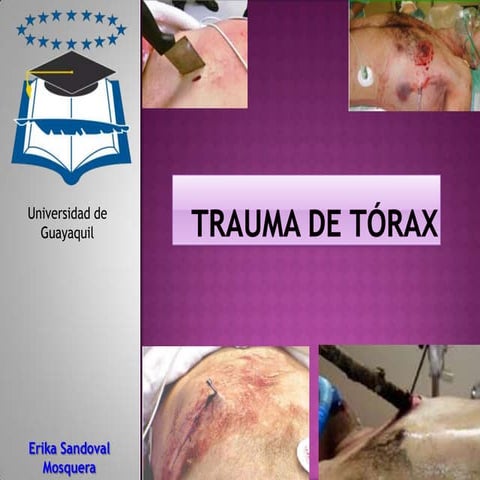Trauma de tórax