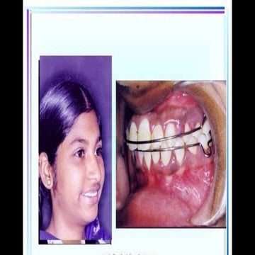 TRCTANGLEVFACE.pptx