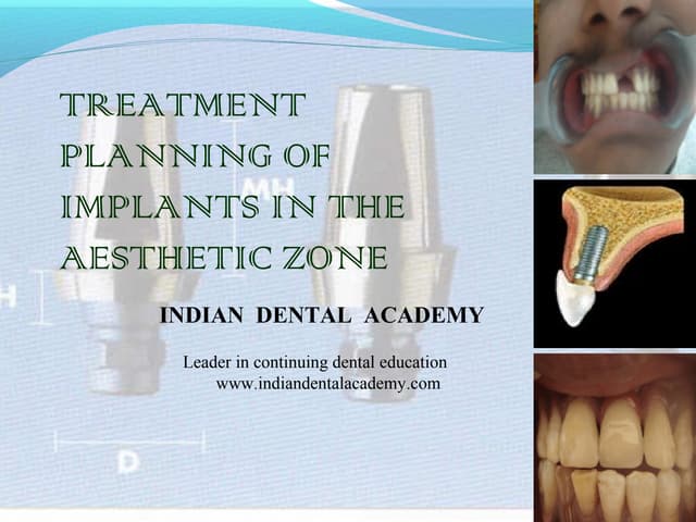 Treatment planning of dental implants   /orthodontic courses by Indian dental...