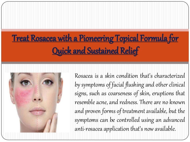 topical treatments for rosacea