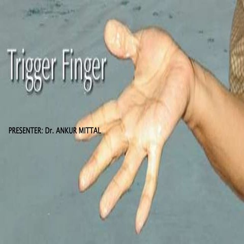 Trigger finger final