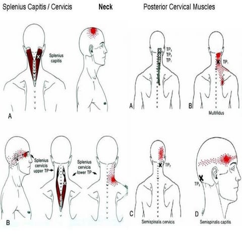 Trigger point 3a | PPT