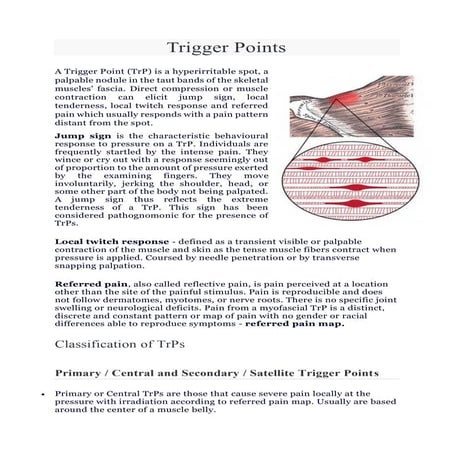 Trigger points & Tender Points