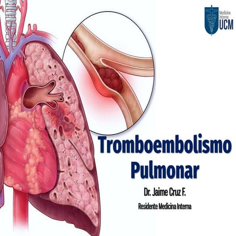 Tromboembolismo pulmonar 