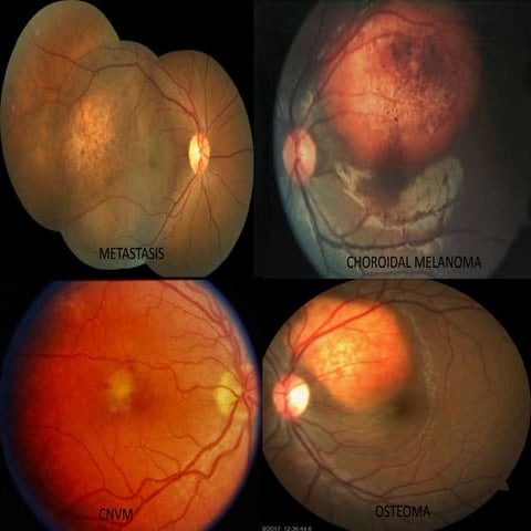 Transpupillary Thermotherapy (TTT)