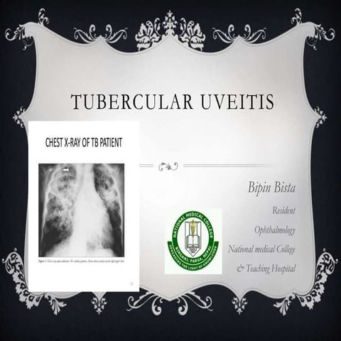 Tubercular uveitis