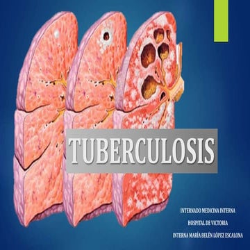 Tuberculosis