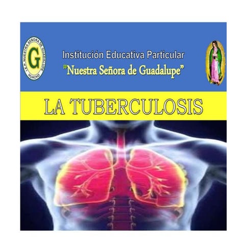 Tuberculosis