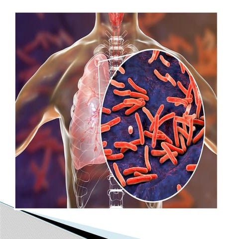 Tuberculosis with a case presentation | PPTX