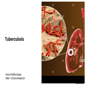 Comprehensive Overview of Tuberculosis: Diagnosis, Treatment, and ...