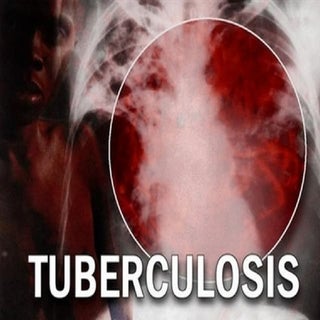 Tuberculosis Pulmonar, Extrapulmona...