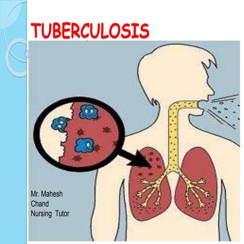 tuberculosis presentation slideshare