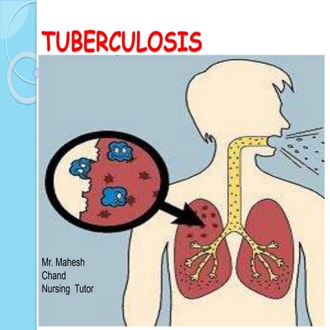Tuberculosis | PPTX