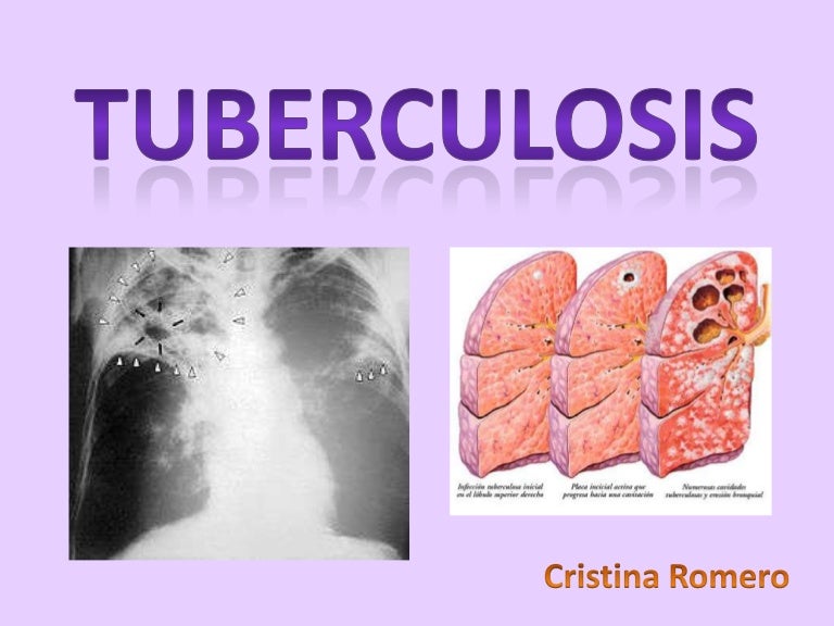 Tuberculosis Ecuador TB