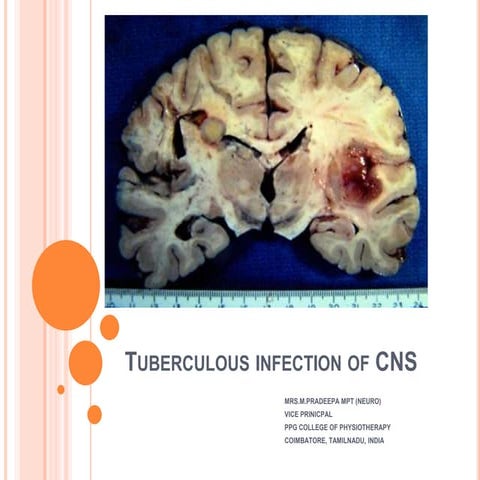 Tuberculous infection of CNS