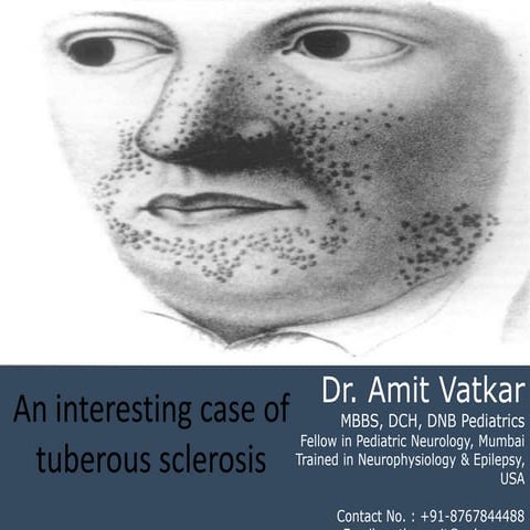 Tuberous sclerosis dr. amit vatkar, pediatric neurologist