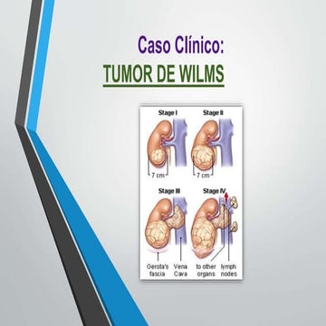 Radiation therapy in wilms tumour | PPT