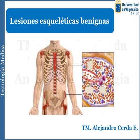 Tumores benignos