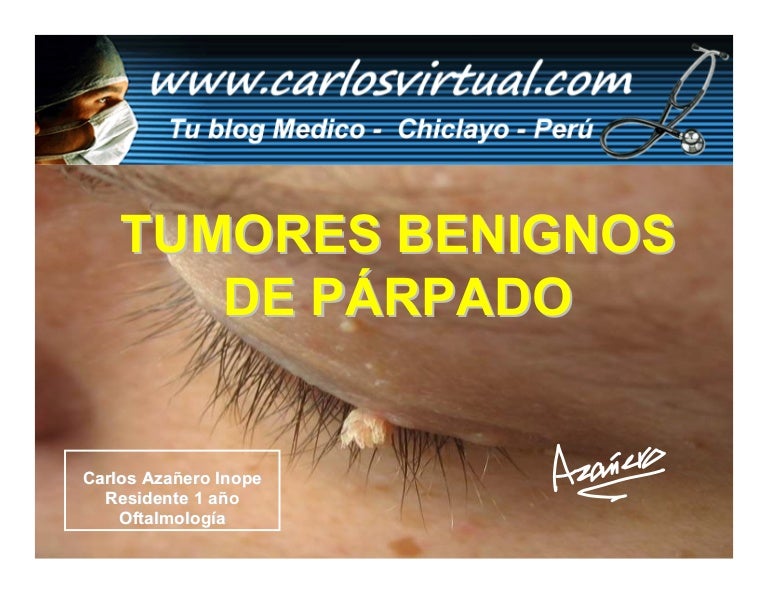 verruga en el borde del parpado superior