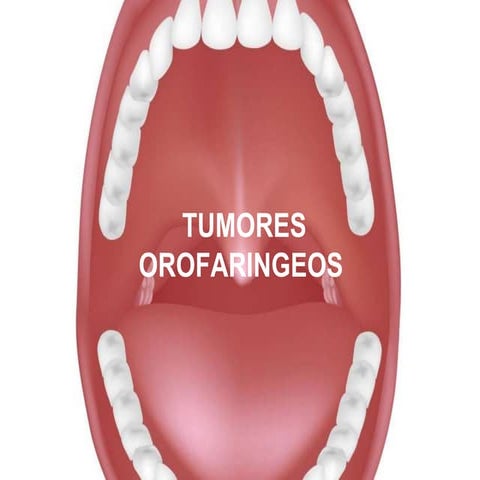 Tumores orofaringeos 