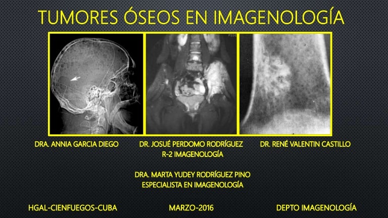 metástasis ósea de cáncer de próstata cura 2