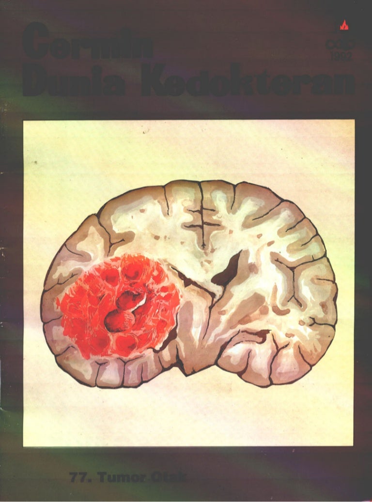 Jual Obat Kanker Kista Epidermoid  Tumor Kista Epidermoid Ampuh