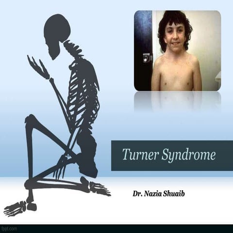 TURNER SYNDROM and causes any type sign symptoms