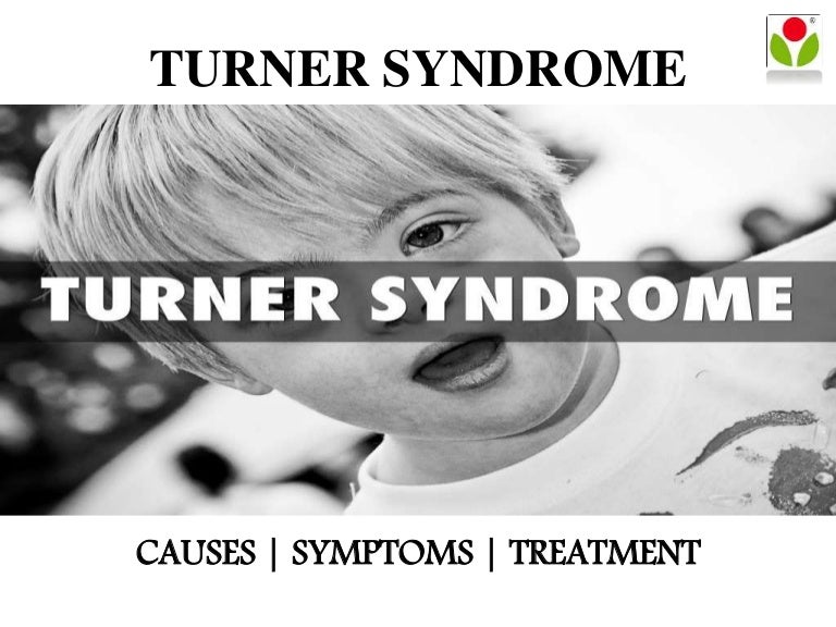 Turner syndrome causes, symptoms and treatment